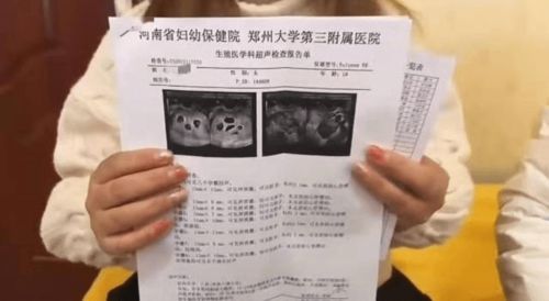 女子打促卵针成功怀上9胞胎，医生建议必须减胎